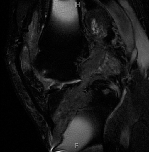 Figure 2 for case ACL reconstruction with particle disease
